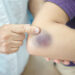 What does it mean when you bruise easily?
