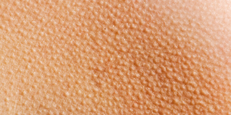 All you need to know about goosebumps