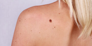 Should we be worried about moles?