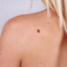 Should we be worried about moles?